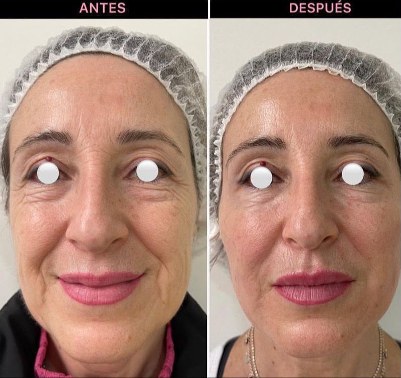 Sculptra