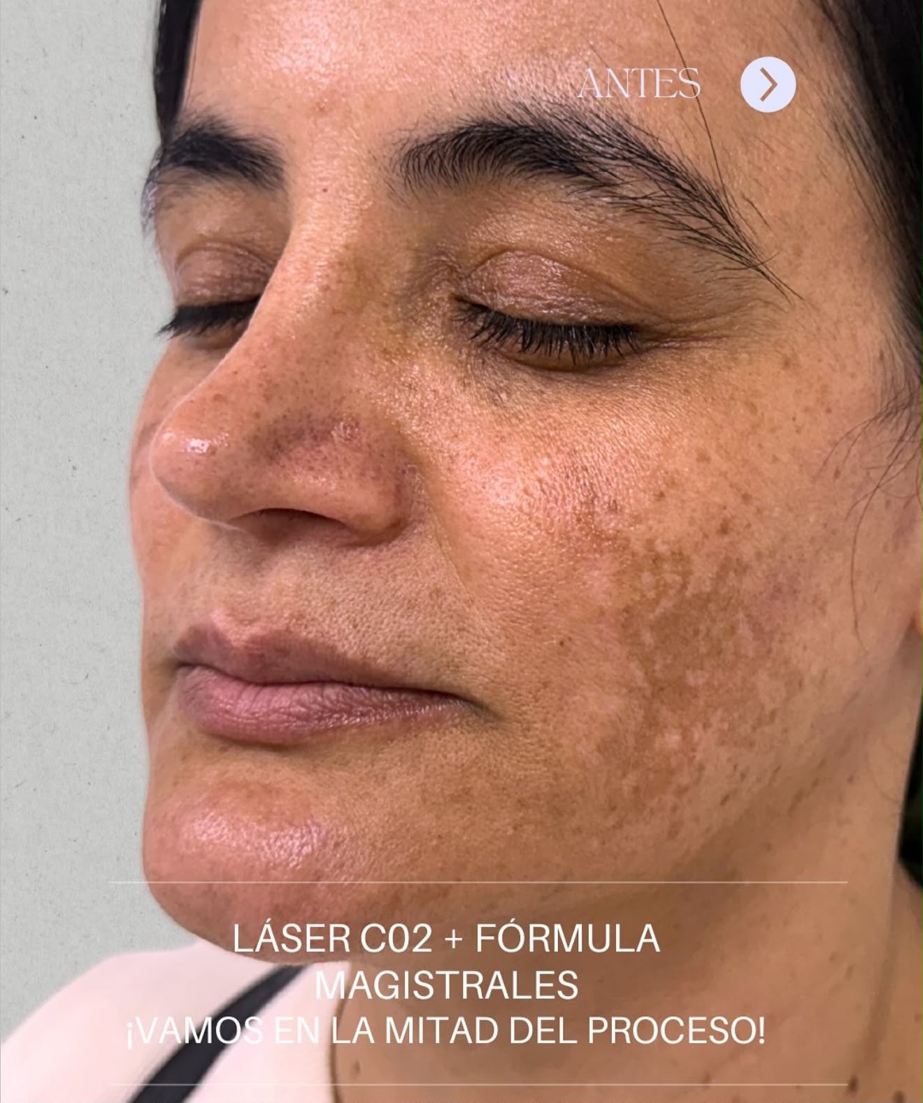 Peeling químico dermatológico (Facial o Corporal)