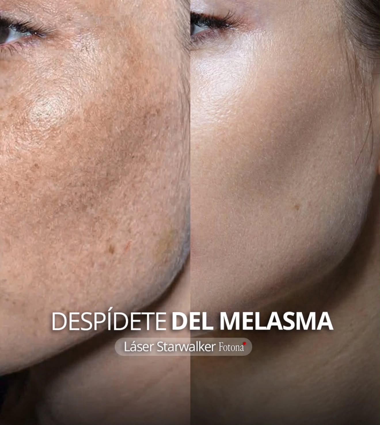 Antes y después Despigmentación Hollywood Peel